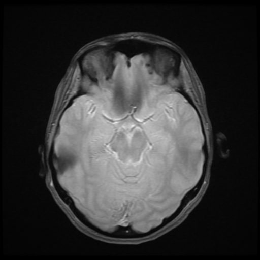 File:Cerebral autosomal dominant arteriopathy with subcortical infarcts and leukoencephalopathy (CADASIL) (Radiopaedia 41018-43768 Ax 2D MERGE 8).png