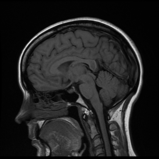 File:Cerebral autosomal dominant arteriopathy with subcortical infarcts and leukoencephalopathy (CADASIL) (Radiopaedia 41018-43768 Sagittal T1 10).png