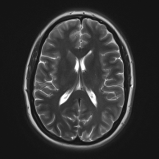 File:Cerebral cavernoma and development venous anomaly (Radiopaedia 37603-39482 Axial T2 13).png