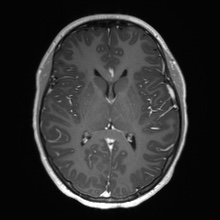 Cerebral cavernous venous malformation (Radiopaedia 70008-80021 Axial T1 C+ 38).jpg