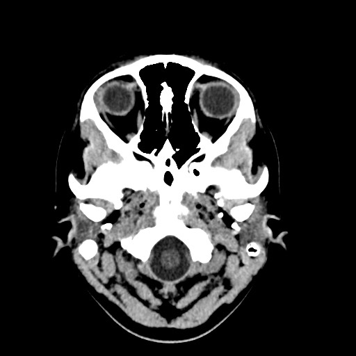 Cerebral cavernous venous malformation (Radiopaedia 70008-80022 Axial non-contrast 2).jpg