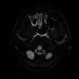 Cerebral cavernous venous malformation (Zabramski type II) (Radiopaedia 85511-101198 Axial DWI 4).jpg