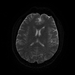 Cerebral cavernous venous malformation (Zabramski type II) (Radiopaedia 85511-101198 Axial DWI 85).jpg