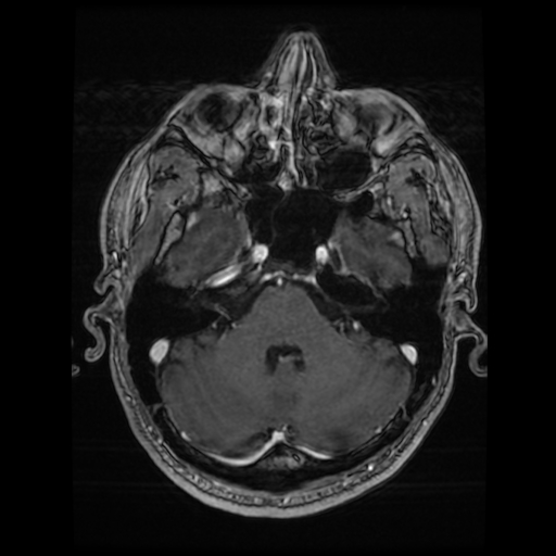 Cerebral cavernous venous malformation (Zabramski type II) (Radiopaedia 85511-101198 Axial T1 C+ fat sat 63).jpg