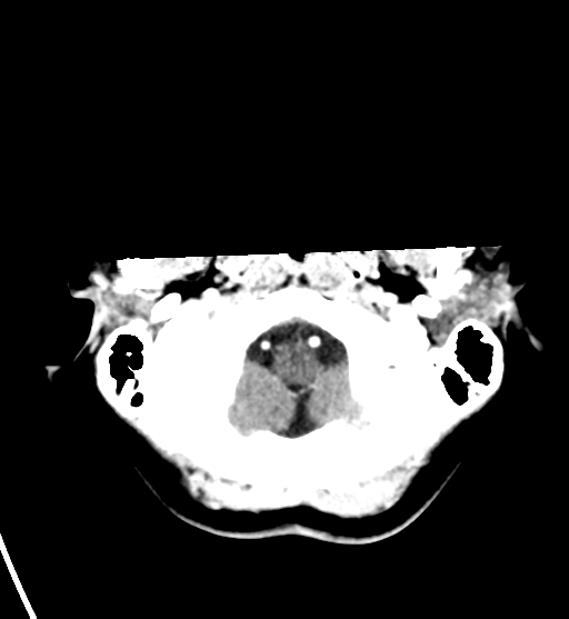 File:Cerebral cavernous venous malformations (Radiopaedia 48117-52945 Axial C+ delayed 6).png