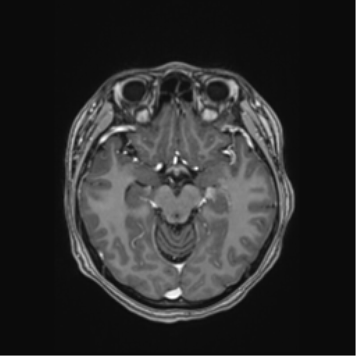 File:Cerebral cavernous venous malformations (Radiopaedia 48117-52946 Axial T1 C+ 22).png