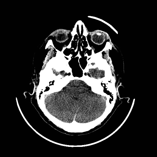 File:Cerebral edema (evolution in time) (Radiopaedia 19418-19439 non-contrast 25).jpg