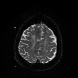 File:Cerebral embolic infarcts (embolic shower) (Radiopaedia 49837-55108 Axial DWI 10).jpg