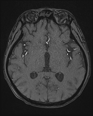Cerebral embolic infarcts (embolic shower) (Radiopaedia 72391-82921 Axial MRA 89).jpg