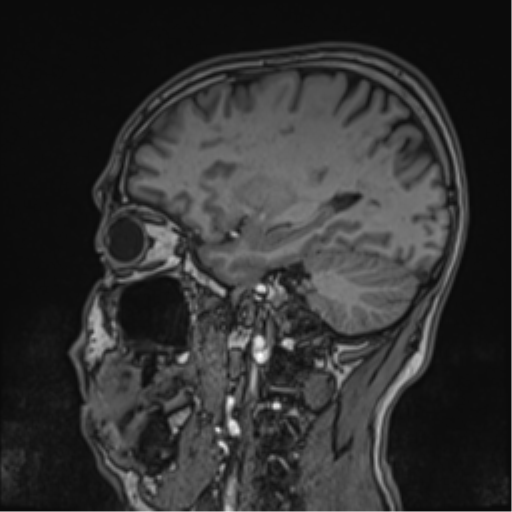 Cerebral fat embolism (Radiopaedia 57697-64639 Sagittal T1 20).png
