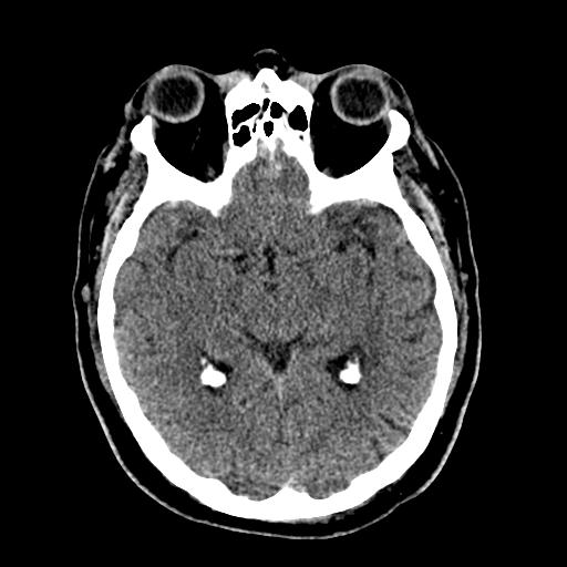 File:Cerebral hemorrhagic contusions and cervical spine fractures (Radiopaedia 32865-33841 Axial non-contrast 16).jpg