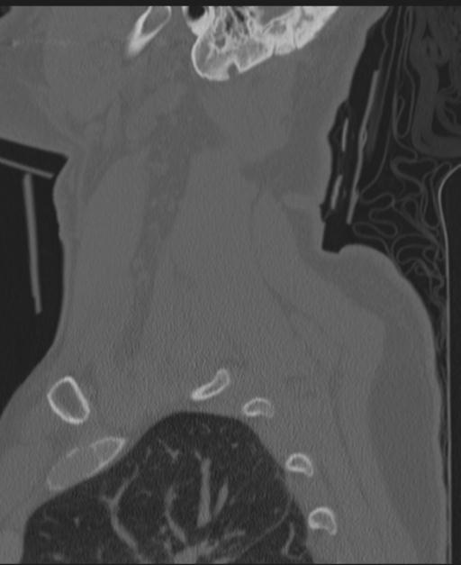 Cerebral hemorrhagic contusions and cervical spine fractures (Radiopaedia 32865-33841 Sagittal bone window 15).jpg