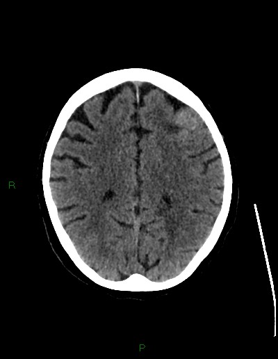 Cerebral metastases - ependymal and parenchymal (Radiopaedia 79877-93131 Axial non-contrast 53).jpg