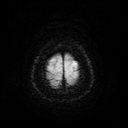 File:Cerebral metastases - melanoma (Radiopaedia 80972-94522 Axial DWI 28).jpg