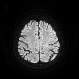 Cerebral metastases - melanoma (Radiopaedia 80972-94522 Axial DWI 54).jpg