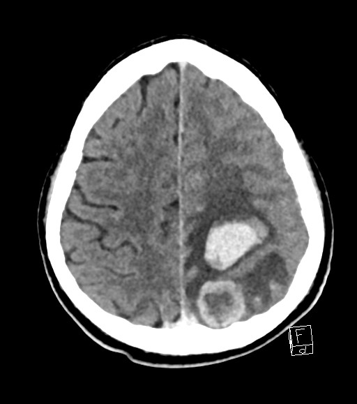 Cerebral metastases - testicular choriocarcinoma (Radiopaedia 84486-99855 Axial C+ delayed 17).jpg