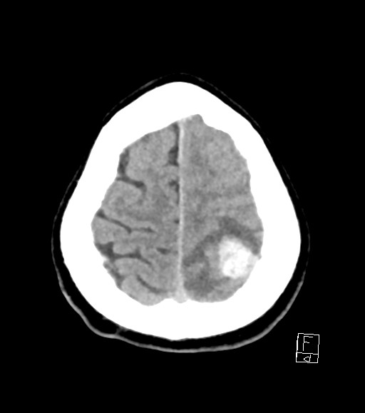 Cerebral metastases - testicular choriocarcinoma (Radiopaedia 84486-99855 Axial non-contrast 11).jpg