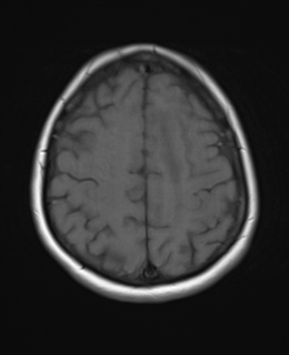 File:Cerebral metastases mimicking abscesses (Radiopaedia 45841-50131 Axial T1 22).png
