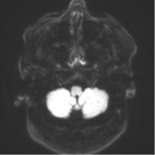 Cerebral metastases mimicking multifocal glioblastoma (Radiopaedia 50843-56353 Axial DWI 32).png