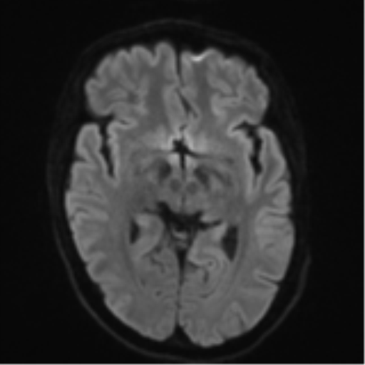 File:Cerebral metastasis - melanoma (Radiopaedia 54718-60954 Axial DWI 44).png