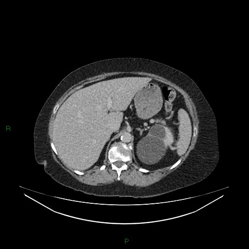Cerebral metastasis from renal cell carcinoma (Radiopaedia 82306-96378 A 42).jpg