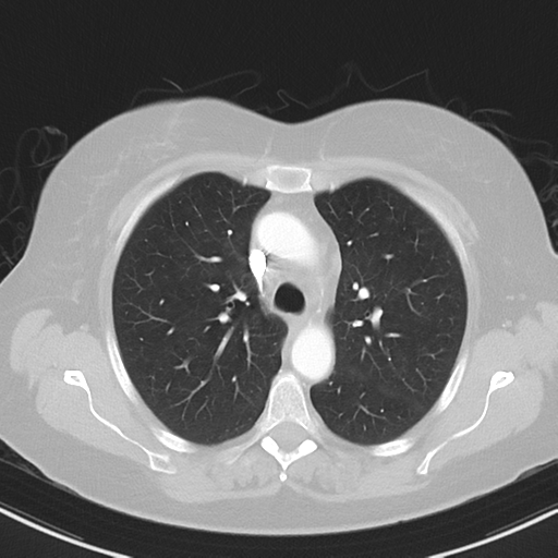 File:Cerebral metastasis mimicking glioblastoma (Radiopaedia 69155-78938 Axial lung window 14).png