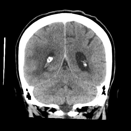 Cerebral metastasis to basal ganglia (Radiopaedia 81568-95412 Coronal C+ delayed 44).png