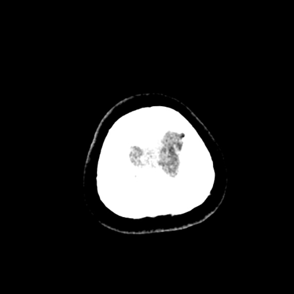 Cerebral ring enhancing lesions - cerebral metastases (Radiopaedia 44922-48818 Axial non-contrast 107).jpg