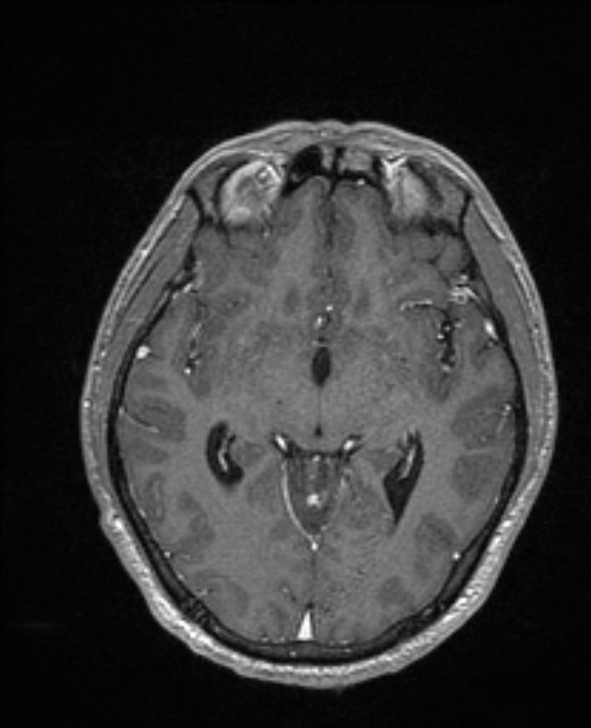 Cerebral toxoplasmosis (Radiopaedia 85779-101597 Axial T1 C+ 75).jpg