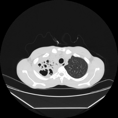 Cerebral tuberculoma (Radiopaedia 80829-94318 Axial lung window 23).jpg
