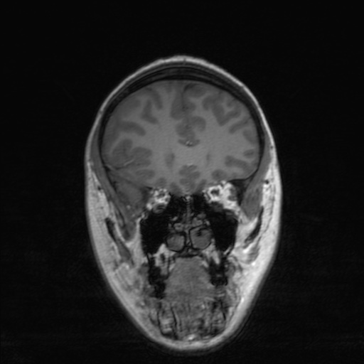 Cerebral tuberculosis with dural sinus invasion (Radiopaedia 60353-68090 Coronal T1 57).jpg