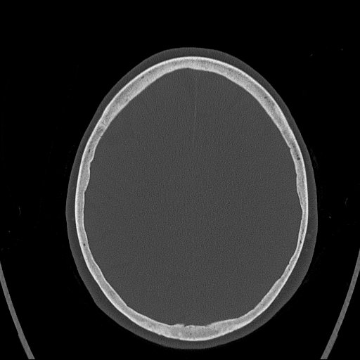Cerebral venous infarction with hemorrhage (Radiopaedia 65343-74381 Axial bone window 132).jpg