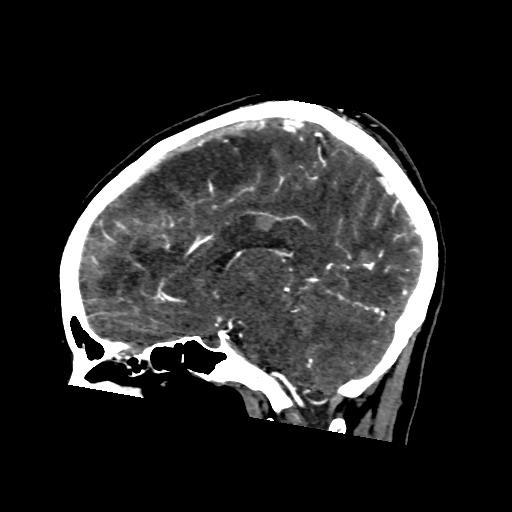 File:Cerebral venous throbmosis - hemorrhagic venous infarction (Radiopaedia 87318-103613 Sagittal CT venogram 20).jpg
