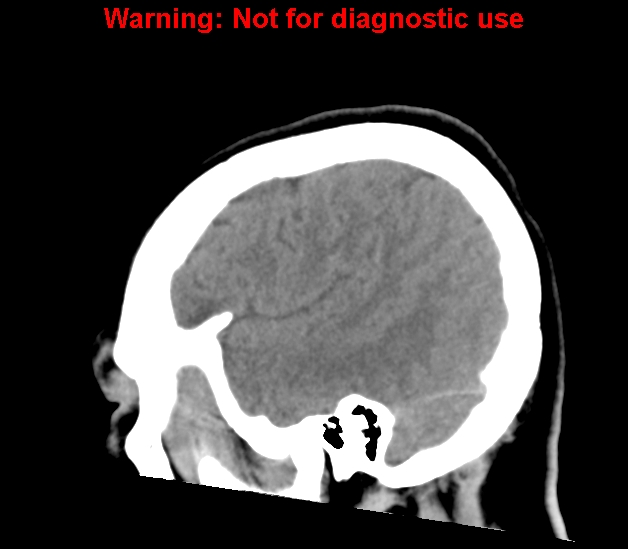 File:Cerebral venous thrombosis (Radiopaedia 37224-38992 B 25).jpg