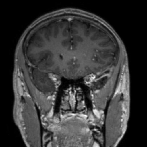 Cerebral venous thrombosis (Radiopaedia 38392-40469 Coronal T1 C+ 64).png