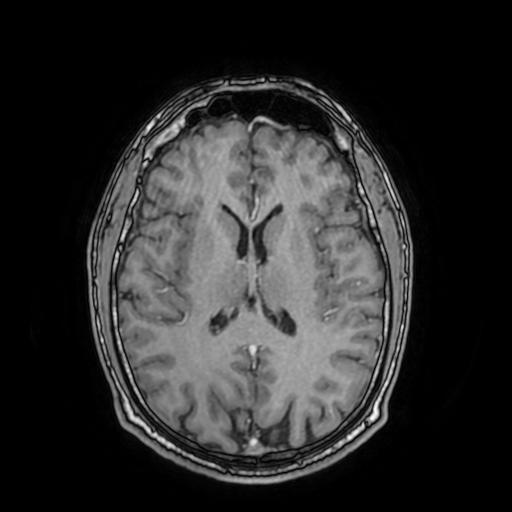 File:Cerebral venous thrombosis with secondary intracranial hypertension (Radiopaedia 89842-106957 Axial T1 C+ 105).jpg