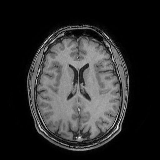 File:Cerebral venous thrombosis with secondary intracranial hypertension (Radiopaedia 89842-106957 Axial T1 C+ 109).jpg