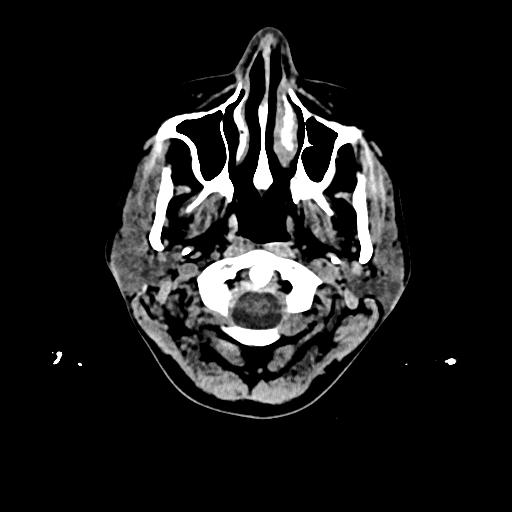 Cerebral venous thrombosis with venous hemorrhagic infarct (Radiopaedia 90354-107660 Axial non-contrast 1).jpg