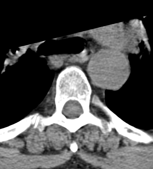 Cervical canal stenosis - OPLL and osteophytes (Radiopaedia 47329-51910 Axial non-contrast 84).png