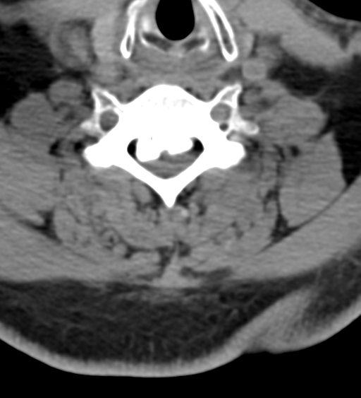 Cervical canal stenosis due to ossification of the posterior longitudinal ligament (Radiopaedia 47260-51823 Axial non-contrast 41).png