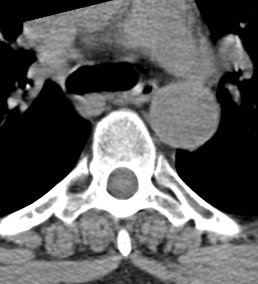 Cervical canal stenosis due to ossification of the posterior longitudinal ligament (Radiopaedia 47260-51823 Axial non-contrast 83).png