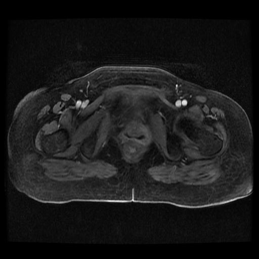 Cervical carcinoma (Radiopaedia 70924-81132 Axial T1 C+ fat sat 207).jpg