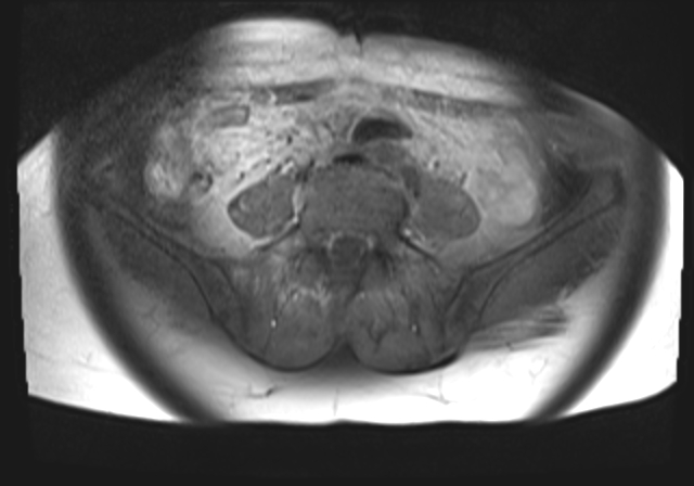 File:Cervical carcinoma (Radiopaedia 88312-104943 Axial T1 fat sat 2).jpg