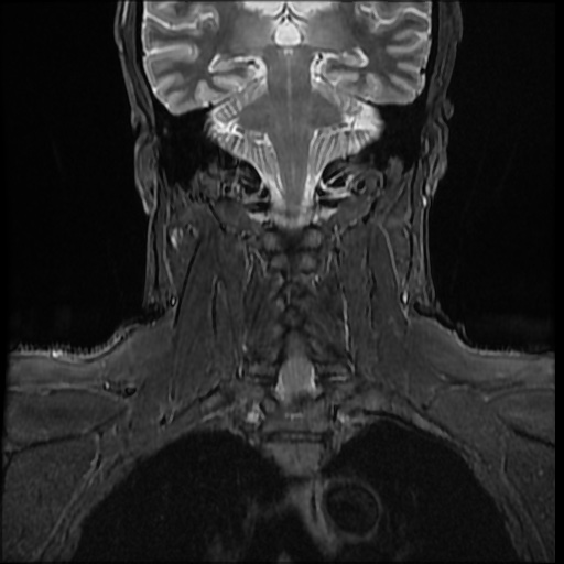 File:Cervical disc extrusion (Radiopaedia 59074-66364 Coronal STIR 8).jpg