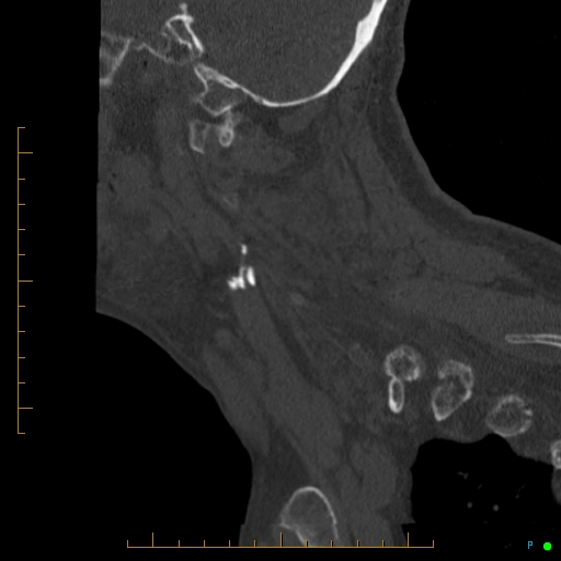 Cervical spine fracture - ankylosing spondylitis (Radiopaedia 76835-88706 Sagittal bone window 88).jpg