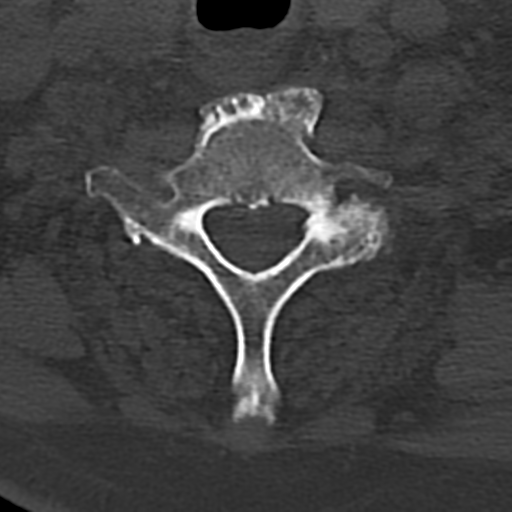 File:Cervical spine fracture - chalk stick (Radiopaedia 39116-41323 Axial bone window 72).png