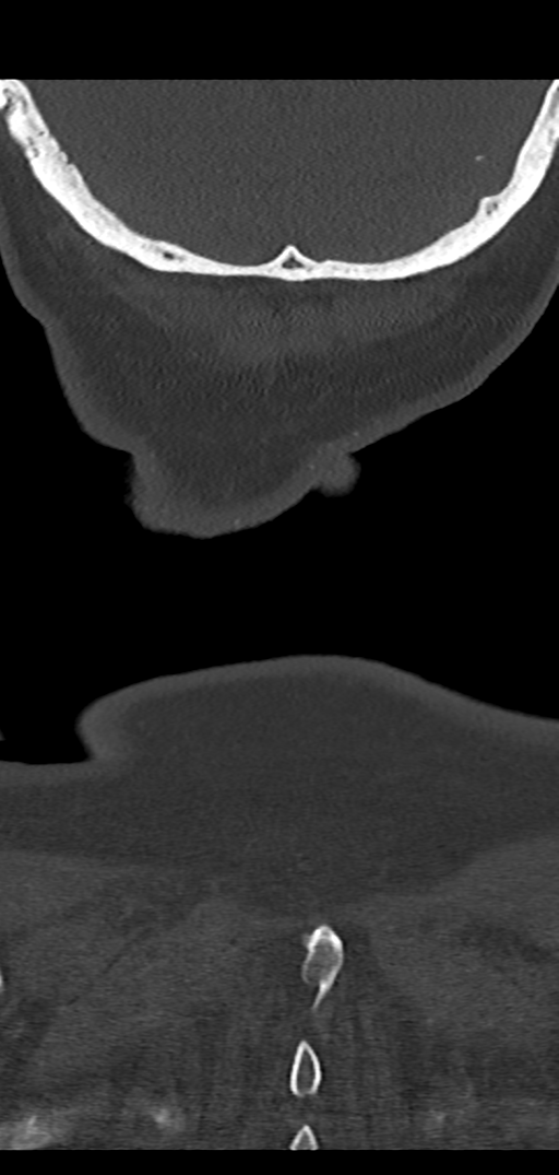 Cervical spine fracture - chalk stick (Radiopaedia 39116-41323 Coronal bone window 57).png