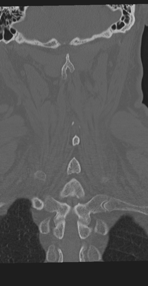 Cervical spine fracture in the setting of ankylosis (Radiopaedia 37038-38715 Coronal bone window 53).png