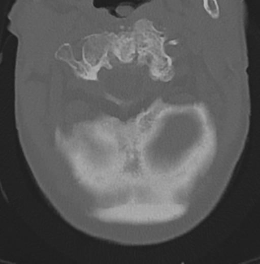 Cervical spondylolysis (Radiopaedia 49616-54811 Axial bone window 13).png