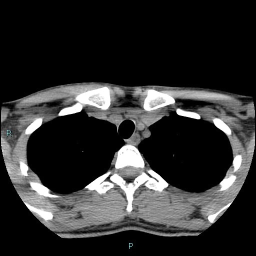 Cervical thymic cyst (Radiopaedia 88632-105335 Axial non-contrast 18).jpg